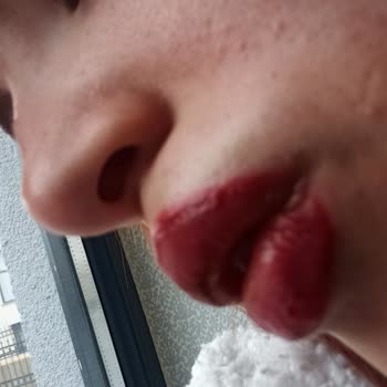 Eny Mila Yanlış Uygulama Sonucu Dudak Sorunları