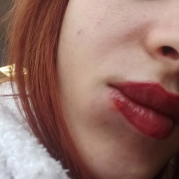 Eny Mila Yanlış Uygulama Sonucu Dudak Sorunları