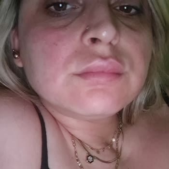 Ciltte Yanma Ve Lekeler: Loreal Paris Revitalift Ürünü