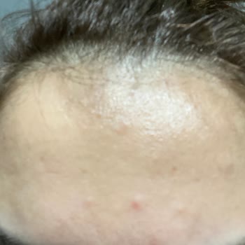 Cilt Ürünleri Cildimi Tahriş Etti