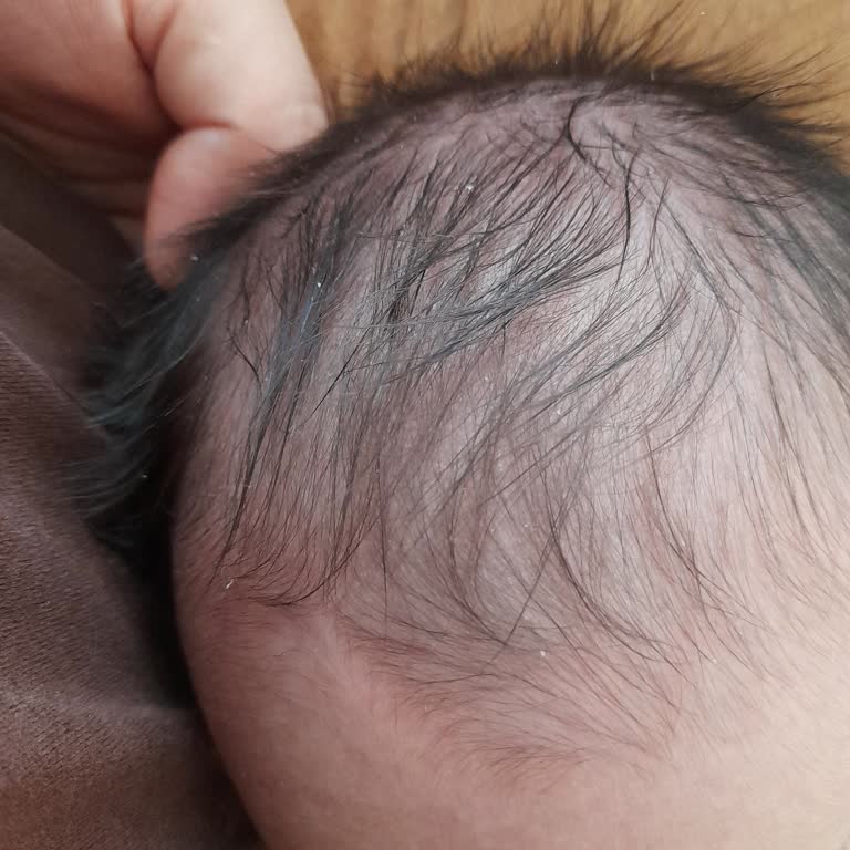 Bebek Şampuanı Kepek Sorunu