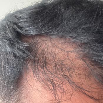 Kepeğe Karşı Şampuan Saç Dökülmesine Neden Oldu