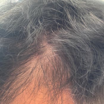 Kepeğe Karşı Şampuan Saç Dökülmesine Neden Oldu