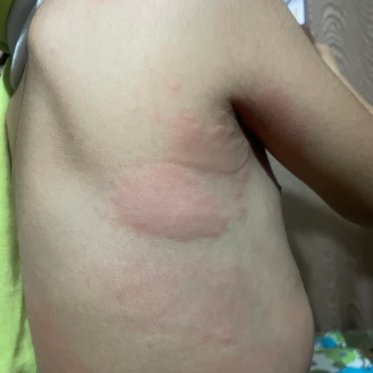 Battalbey Çiğköfte Alerjisi: Çocuklarınızı Koruyun!