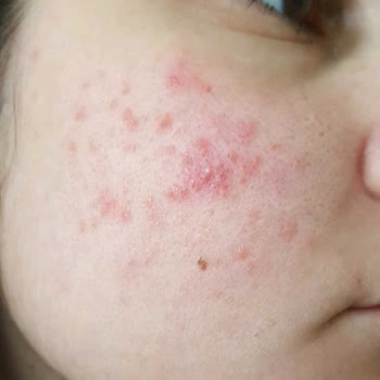 Garnier Makyaj Temizleme Suyu Ve Cilt Reaksiyonu