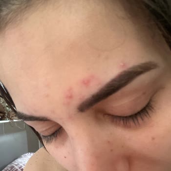 Yves Rocher Hydra Vegetal Yüz Kremi İle Alerjik Reaksiyon