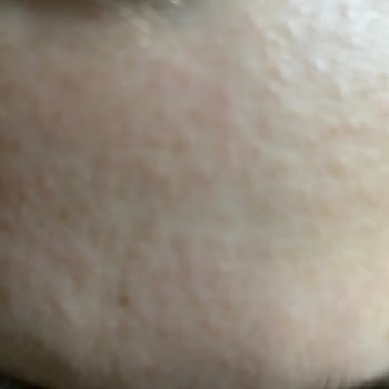 Yves Rocher Hydra Vegetal Yüz Kremi İle Alerjik Reaksiyon