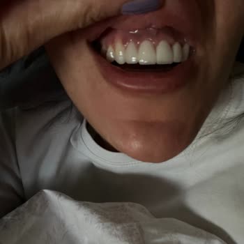 Clinic Lina Eksik Kontrol Ve Yanlış Tedavi Sonrası Mağduriyet