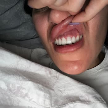 Clinic Lina Eksik Kontrol Ve Yanlış Tedavi Sonrası Mağduriyet