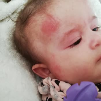 Dalin Avokadolu Şampuan Bebeklerde Cilt Sorunlarına Yol Açıyor