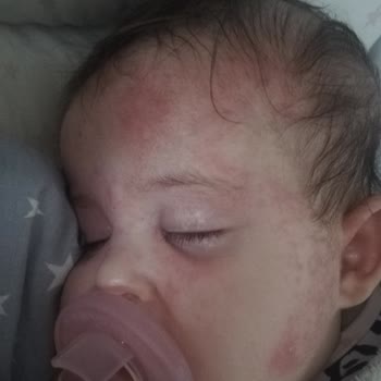 Dalin Avokadolu Şampuan Bebeklerde Cilt Sorunlarına Yol Açıyor