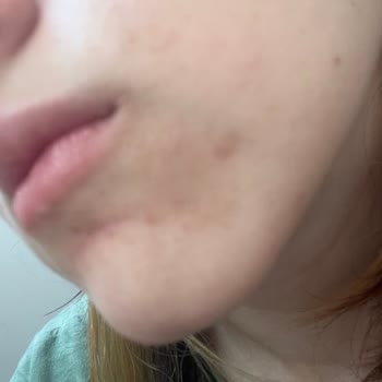 Anyong Alerjik Reaksiyon: Akne Karşıtı Ürün Sorunu!