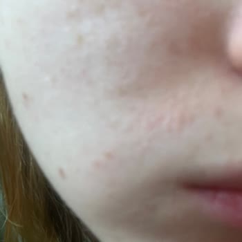 Anyong Alerjik Reaksiyon: Akne Karşıtı Ürün Sorunu!