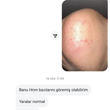 İğneli Epilasyon Hayal Kırıklığı Ve İlgisizlik