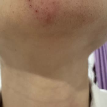 İğneli Epilasyon Hayal Kırıklığı Ve İlgisizlik