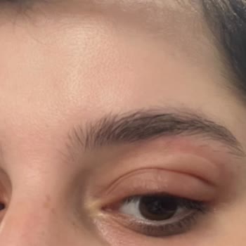 Skin Sensual Göz Serumuyla Gelen Beklenmedik Alerjik Reaksiyon