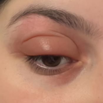 Skin Sensual Göz Serumuyla Gelen Beklenmedik Alerjik Reaksiyon