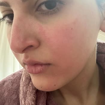 Cilt Yanığına Sebep Olan Temizleyici