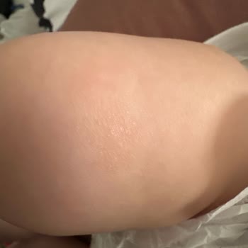 Bebek Şampuanı Egzama Sorunu Yarattı