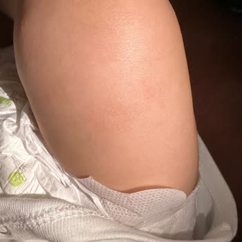 Bebek Şampuanı Egzama Sorunu Yarattı