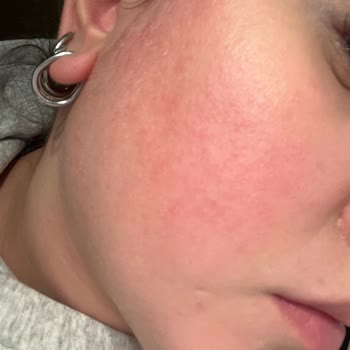 Cildimde Kızarıklık Ve Kaşıntıya Sebep Olan Highlighter