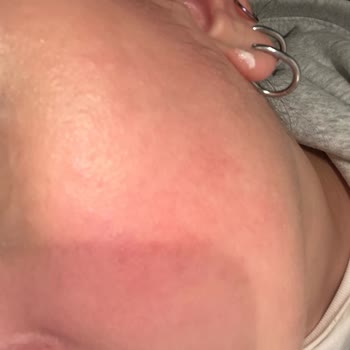 Cildimde Kızarıklık Ve Kaşıntıya Sebep Olan Highlighter