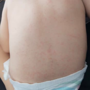 Atopik Ciltler İçin Uygun Olmayan Ürün