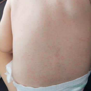 Atopik Ciltler İçin Uygun Olmayan Ürün