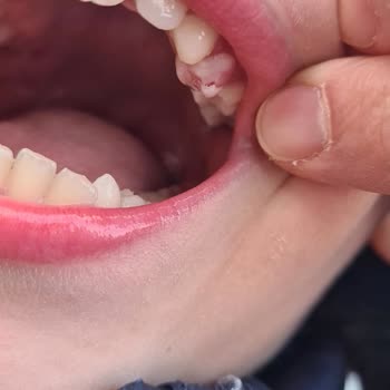 Hamburgerdeki Gizli Tehlike: Çocuğumun Dişi Kırıldı!