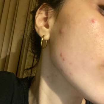 Origins Moisturizer Caused Severe Breakouts After Just Two Uses