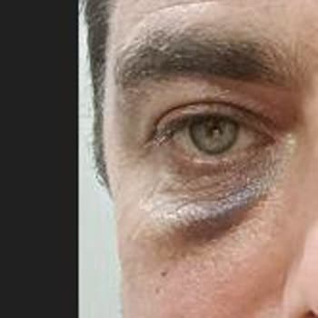 Göz Altı Dolgusu Kabusu: Morluklar Ve İlgisizlik