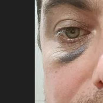 Göz Altı Dolgusu Kabusu: Morluklar Ve İlgisizlik