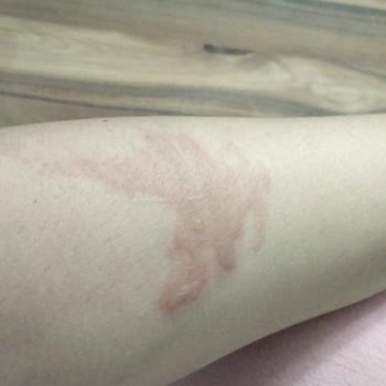 Patlayan Düdüklü Tencere Kabusu