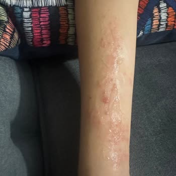 Argivit Kullanımı Sonrası Cilt Reaksiyonu Ve İade Talebi