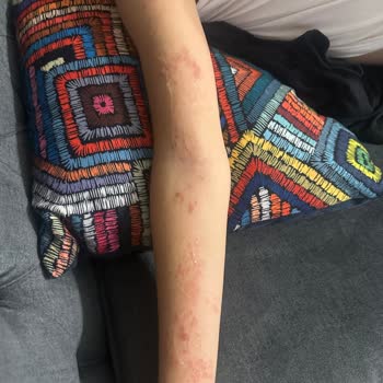 Argivit Kullanımı Sonrası Cilt Reaksiyonu Ve İade Talebi