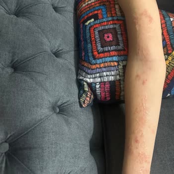 Argivit Kullanımı Sonrası Cilt Reaksiyonu Ve İade Talebi