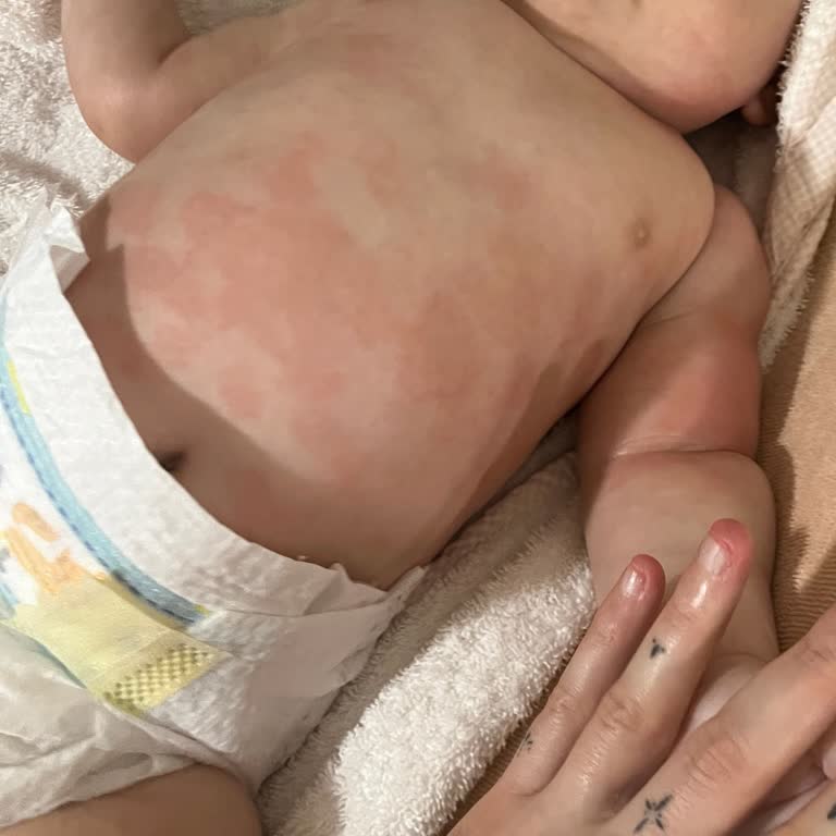 Bebek Cildinde Mustela Ürünleri Sonrası Sorunlar