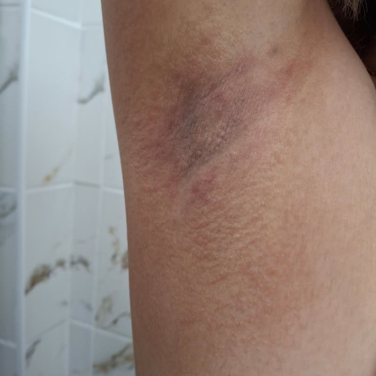 Yves Rocher Roll On Ürünü Cilt Tahrişine Sebep Oldu!