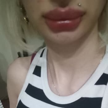 Aşırı Dolgu Sonrası Depresyon Ve Yardım Çağrısı