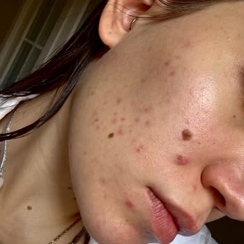 Medik8 Ürünleri: Hayal Kırıklığı Ve Cilt Sorunları