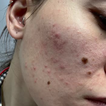 Medik8 Ürünleri: Hayal Kırıklığı Ve Cilt Sorunları