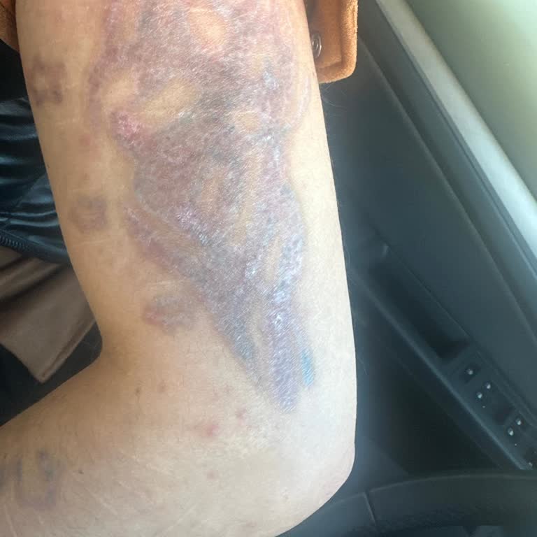 Dövme Silme Hizmetinde Hayal Kırıklığı