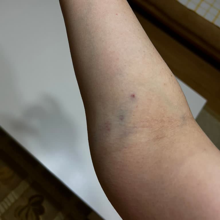 Hastanede Yanlış Damar Yolu Uygulaması Sonrası Yaşanan Acı Ve Sorunlar