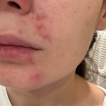 Clinique Moisture Surge Gave Me Acne and I Want My Money Back