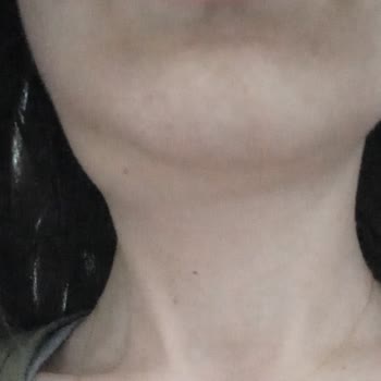 Macrol Antibiyotik Kullanımı Sonrası Sağlık Sorunları