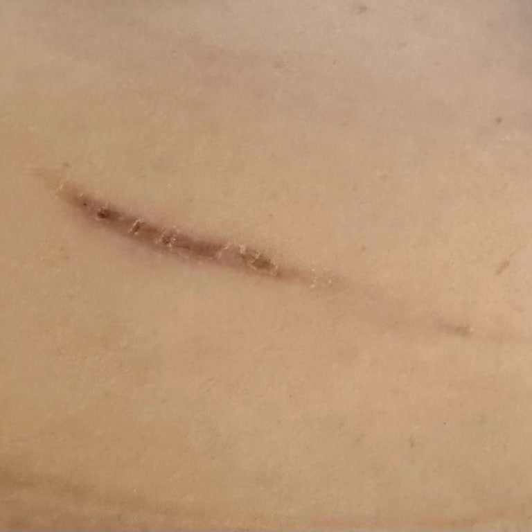 Penti Sütyenleri Sağlık Sorunlarına Yol Açtı