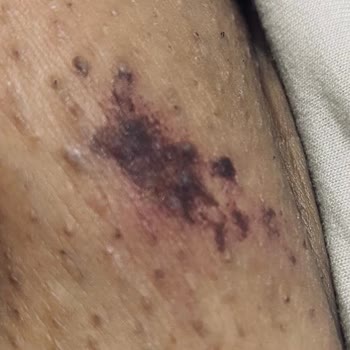 Lazer İşleminde Yaşanan Sorunlar