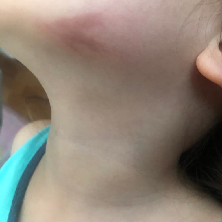 Çocuklar İçin Tehlikeli Ürün: Ena Cold Mix Yanığı