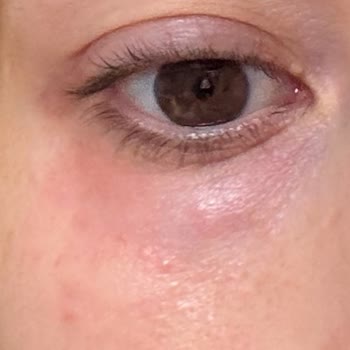 Garnier Micellar Temizleme Suyuyla Ciltte Yanma Ve Tahriş