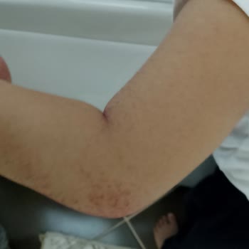 H&M, polares oscuros mancharon la piel de mi hijo